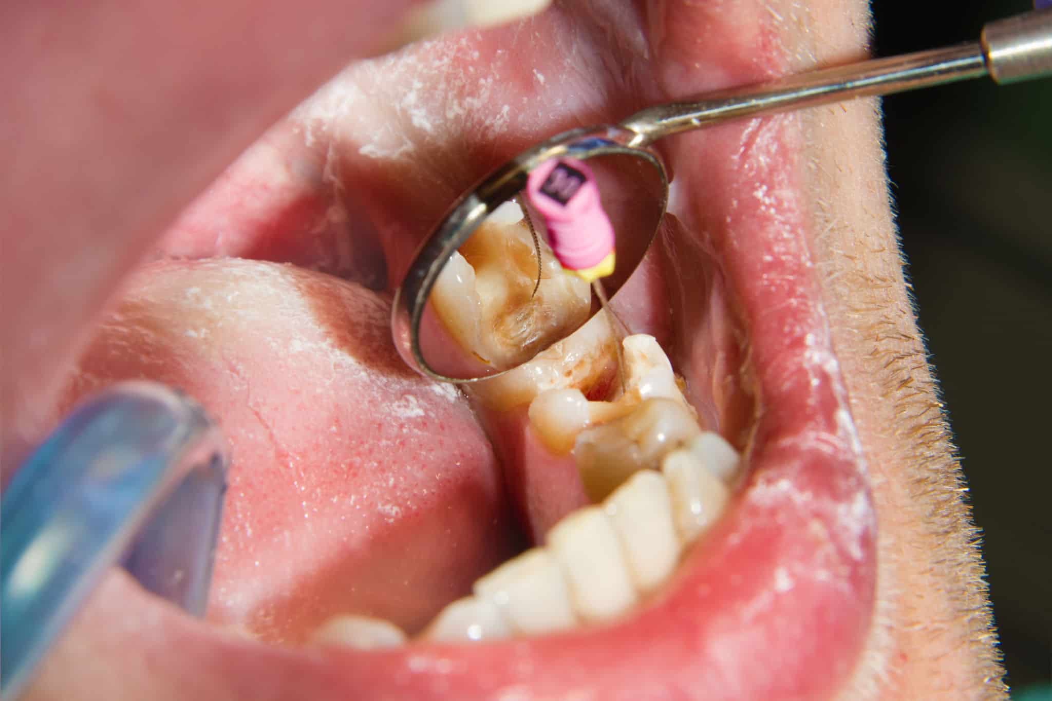 Closeup of root canal procedure